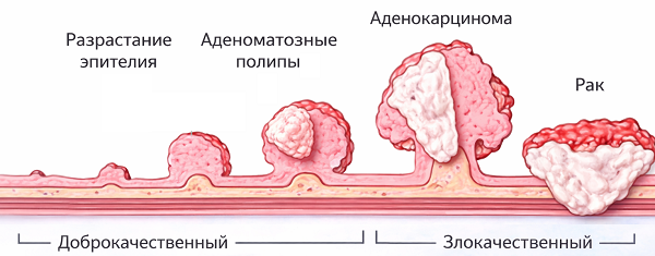 Полипы эндометрия: перерождение в онкологию