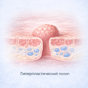Гиперпластический полип прямой кишки без дисплазии