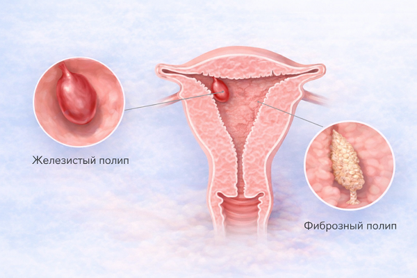 Полипы эндометрия: анатомическое расположение