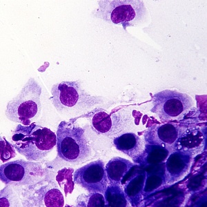 Хламидиоз - Медицина и красота