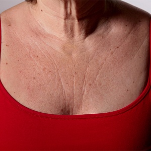 Обвисшая грудь - Медицина и красота