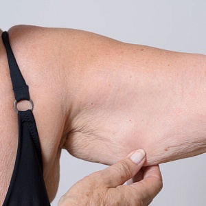 Дряблая кожа - Медицина и красота