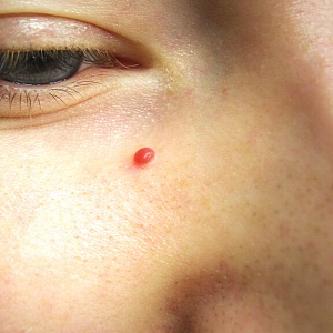 Гемангиомы - Медицина и красота