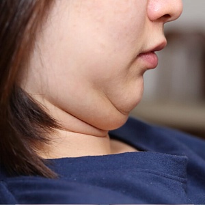 Второй подбородок - Медицина и красота