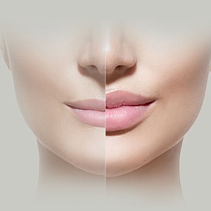 Тонкие губы - Медицина и красота