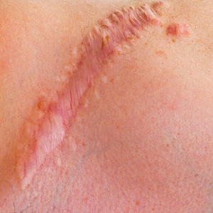 Шрамы, рубцы - Медицина и красота