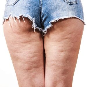 Целлюлит - Медицина и красота