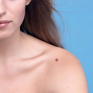 Родинки - Медицина и красота