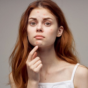 Акне - Медицина и красота