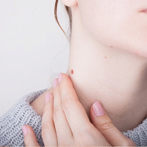 Бородавки - Медицина и красота