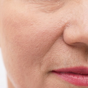 Носогубные складки - Медицина и красота