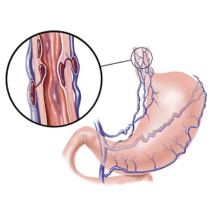Варикозное расширение вен пищевода и желудка - Медицина и красота