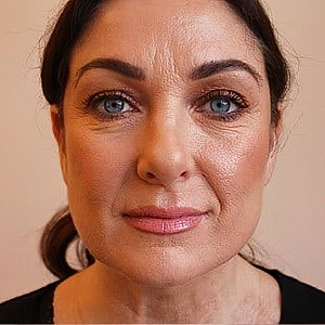 Мимические морщины - Медицина и красота