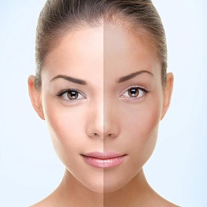 Ассиметрия лица - Медицина и красота