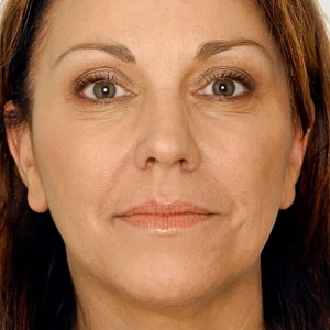 Птоз (опущение тканей лица) - Медицина и красота