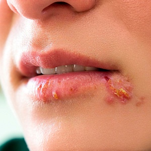 Стрептодермия - Медицина и красота