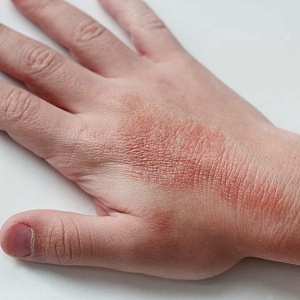 Атопический дерматит - Медицина и красота