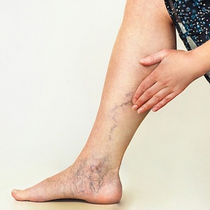 Ретикулярный варикоз (нижних конечностей) - Медицина и красота