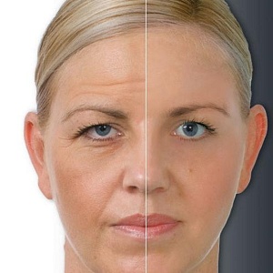 Опущение уголков губ, глаз и бровей - Медицина и красота