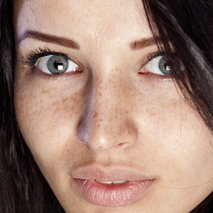 Пигментные пятна и веснушки - Медицина и красота