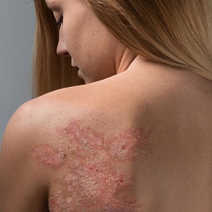 Экзема - Медицина и красота