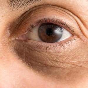 Круги, мешки под глазами - Медицина и красота