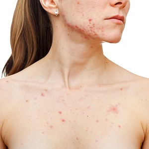 Пиодермии - Медицина и красота