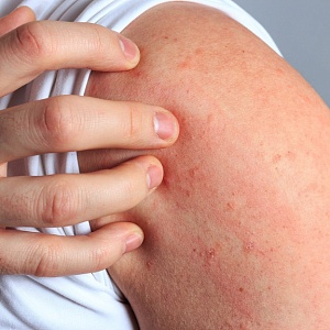 Аллергический дерматит - Медицина и красота