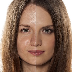 Жирная кожа - Медицина и красота