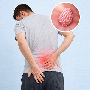 Анальные папилломы - Медицина и красота